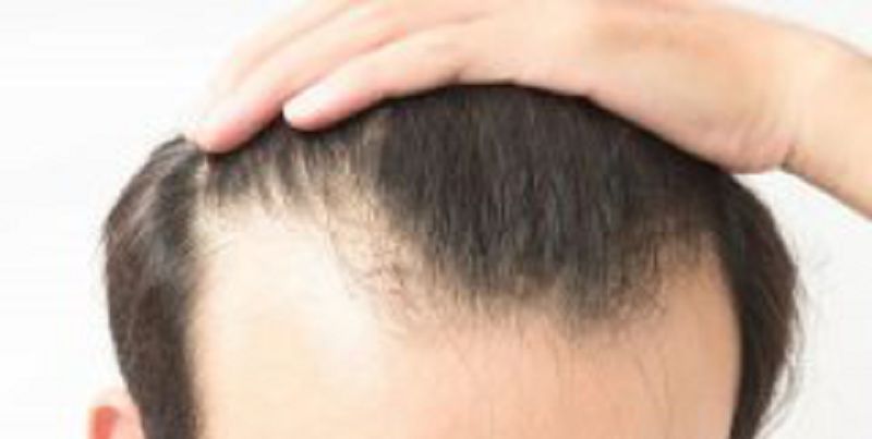 额角植发真的有效吗？